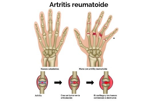 ARTRITIS REUMATOIDE: UNA ENFERMEDAD PREVALENTE EN CUENCA.